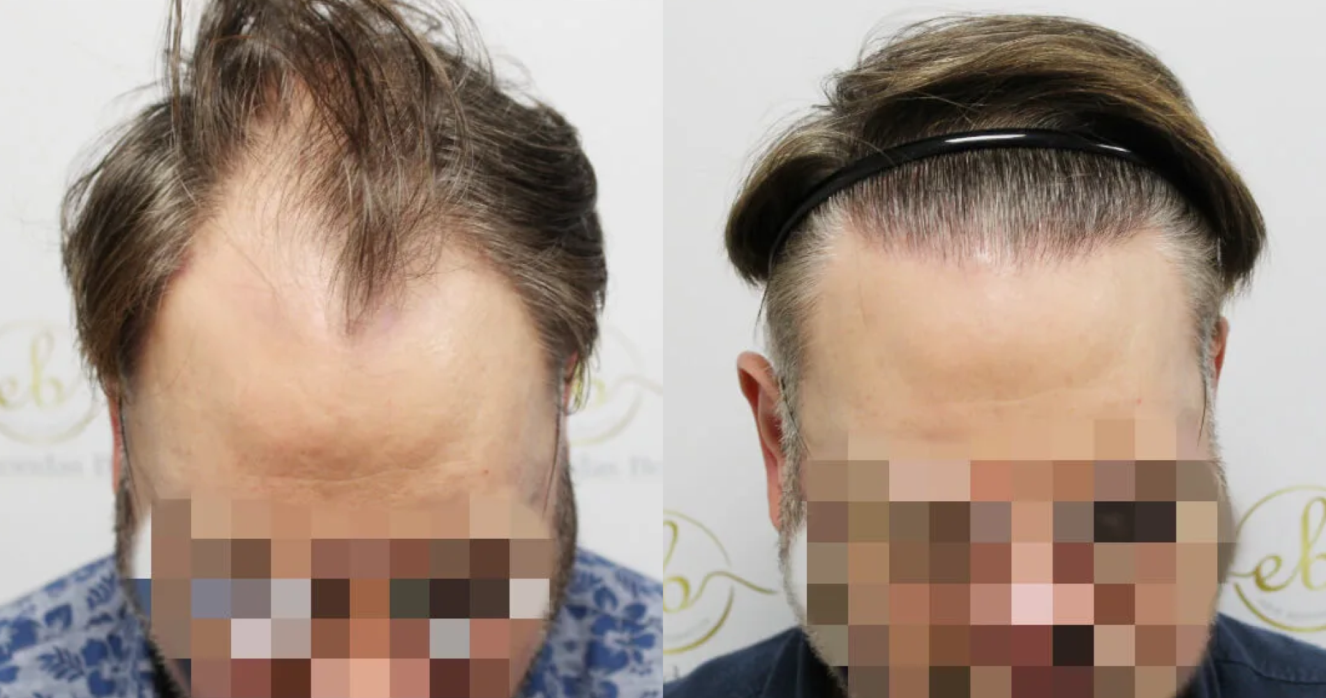 Unshaven FUE<br>Hair Transplant