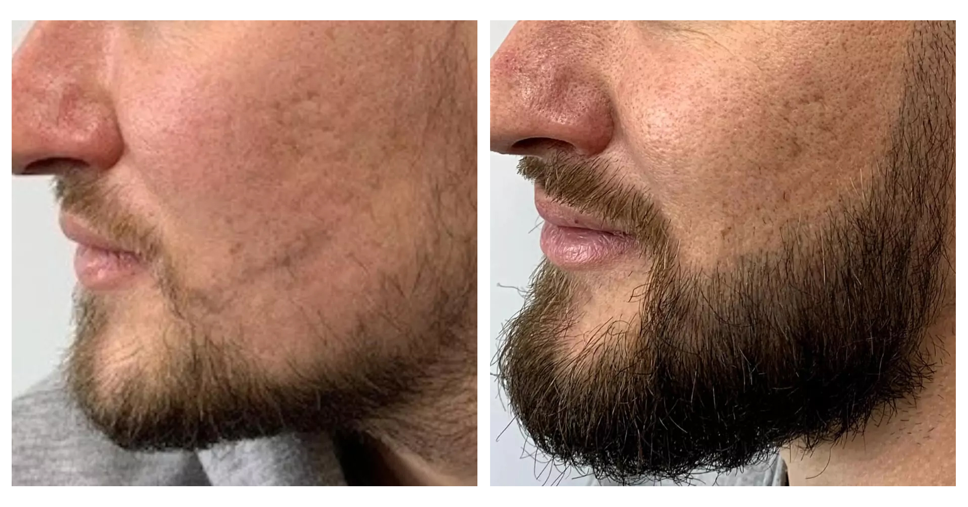 Beard<br>Restoration