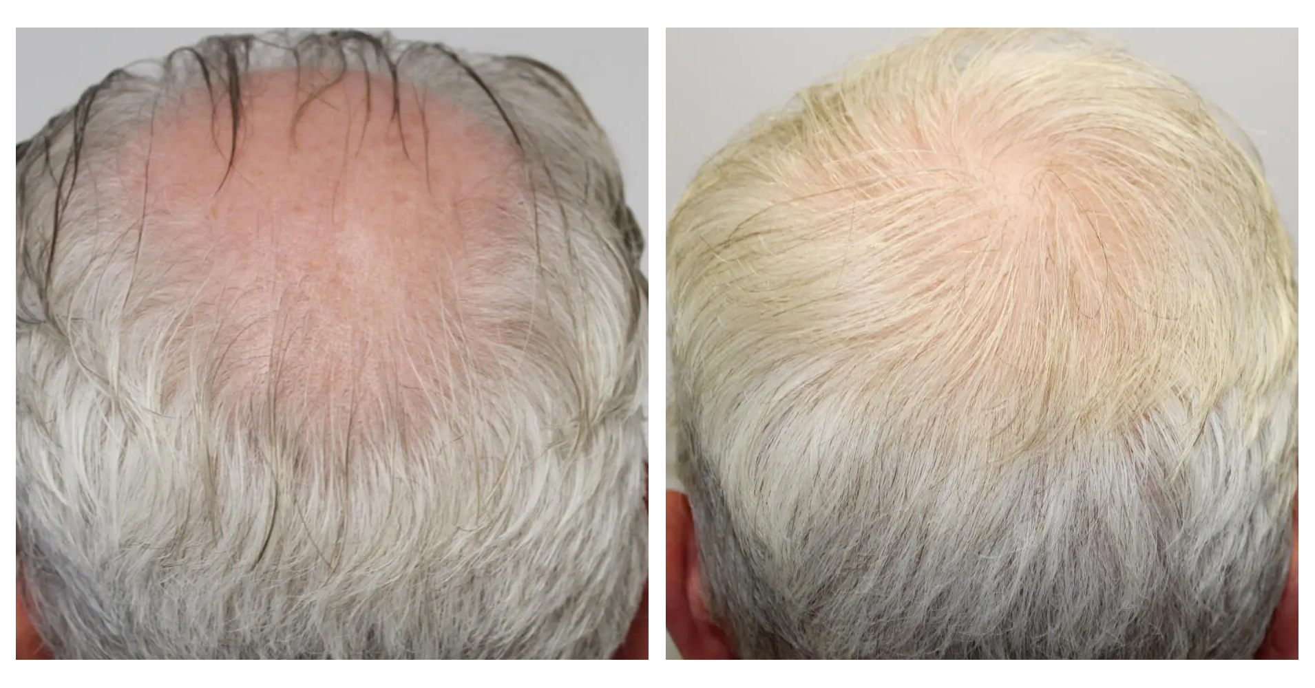 Crown Hair<br>Transplant