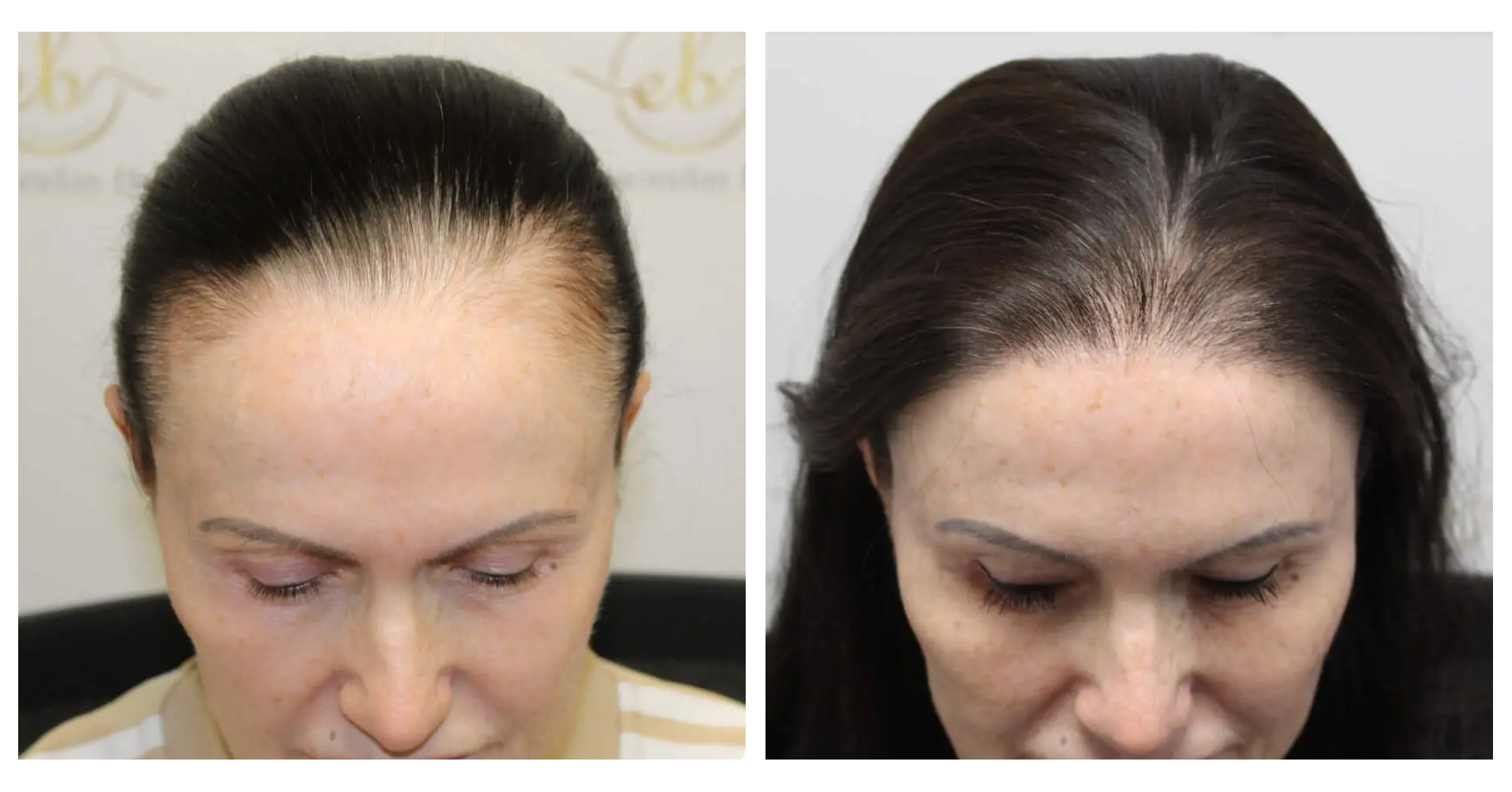 Female Hair<br>Transplant