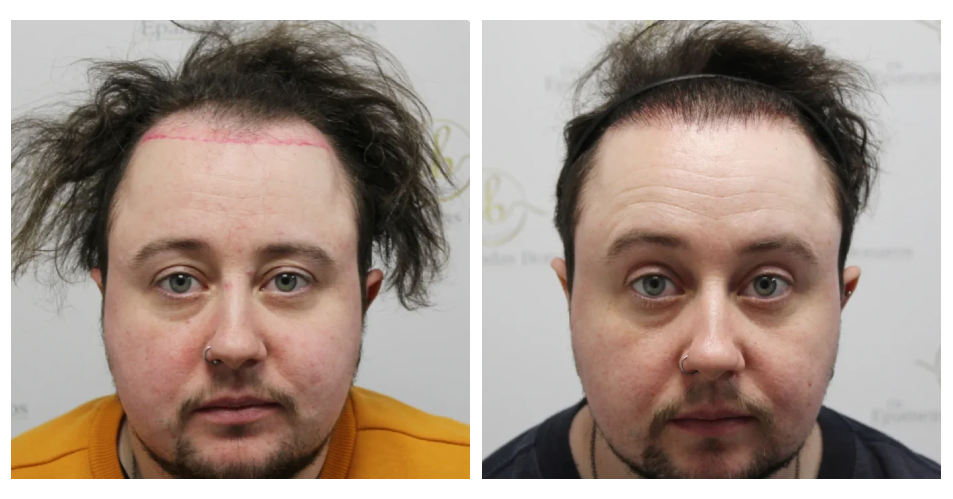 FtM Hair<br>Transplant