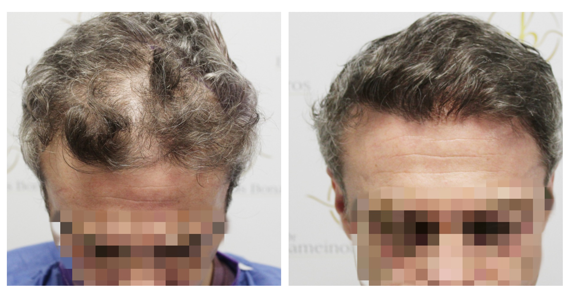 FUE Hair<br>Transplant