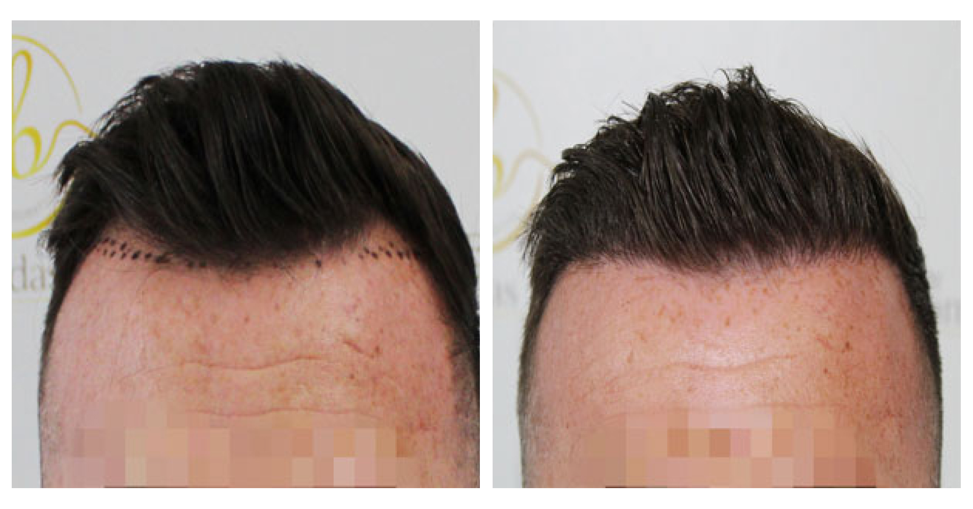 Hairline<br>Transplant