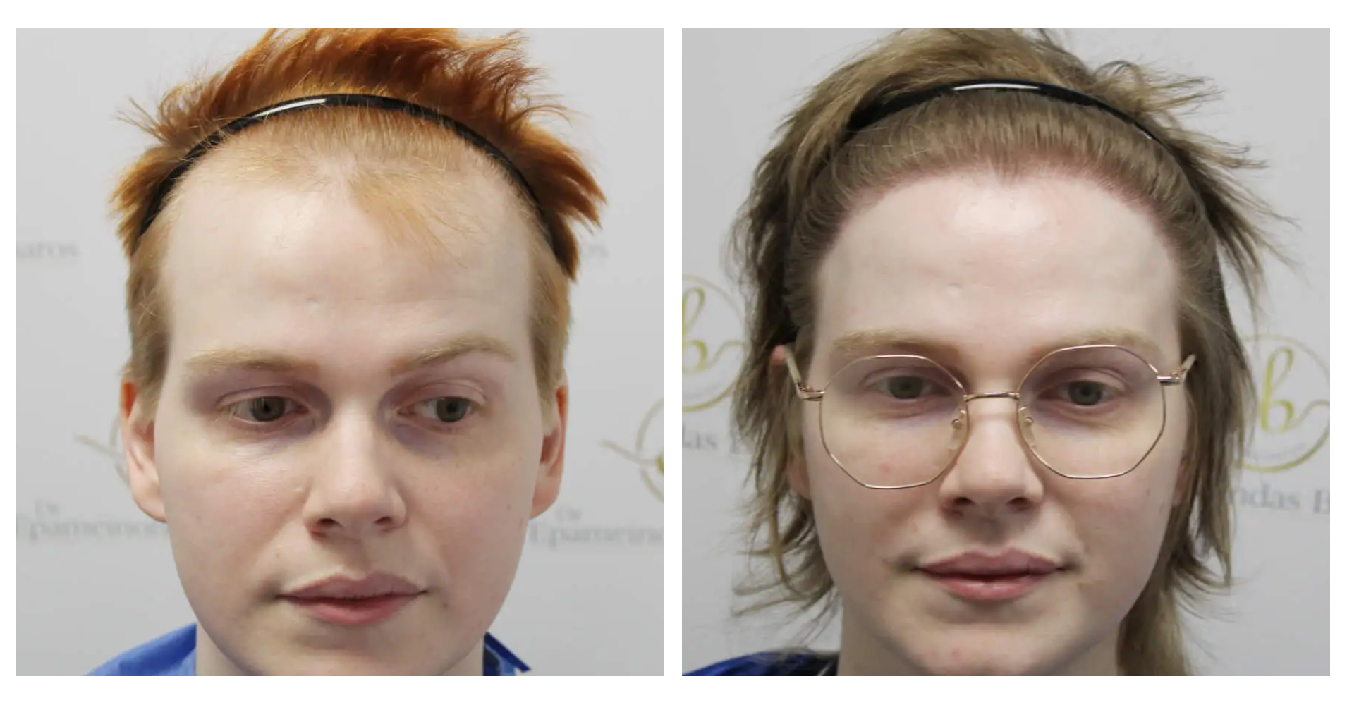 MtF Hair<br>Transplant