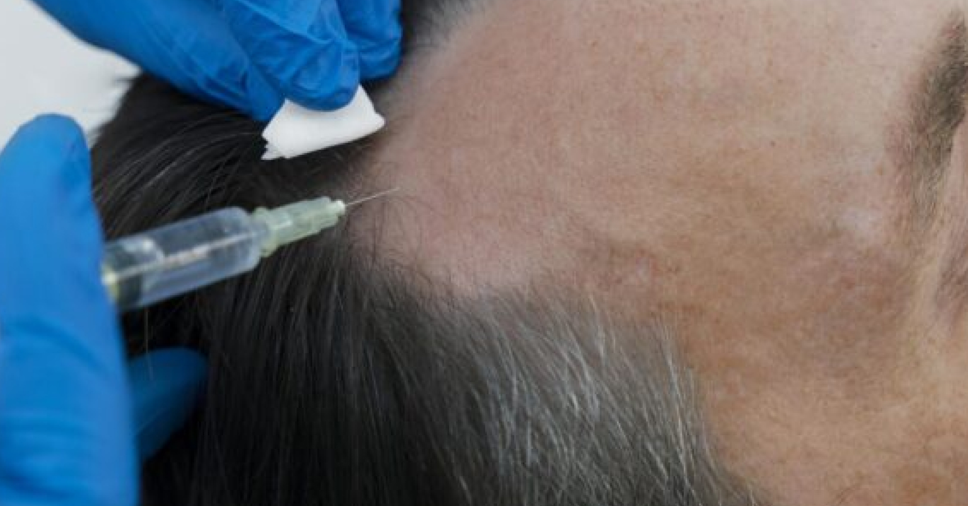 Non-Surgical<br>Hair Treatment