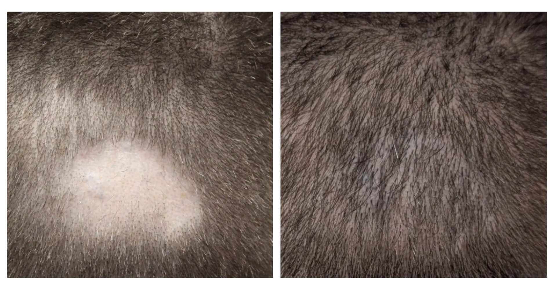 Scar Repair<br>Hair Transplant