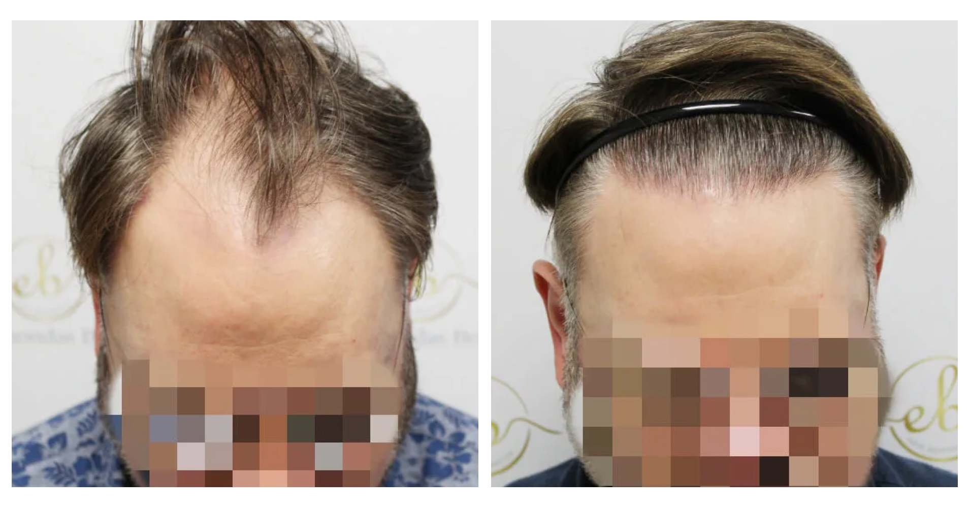 Unshaven FUE<br>Hair Transplant