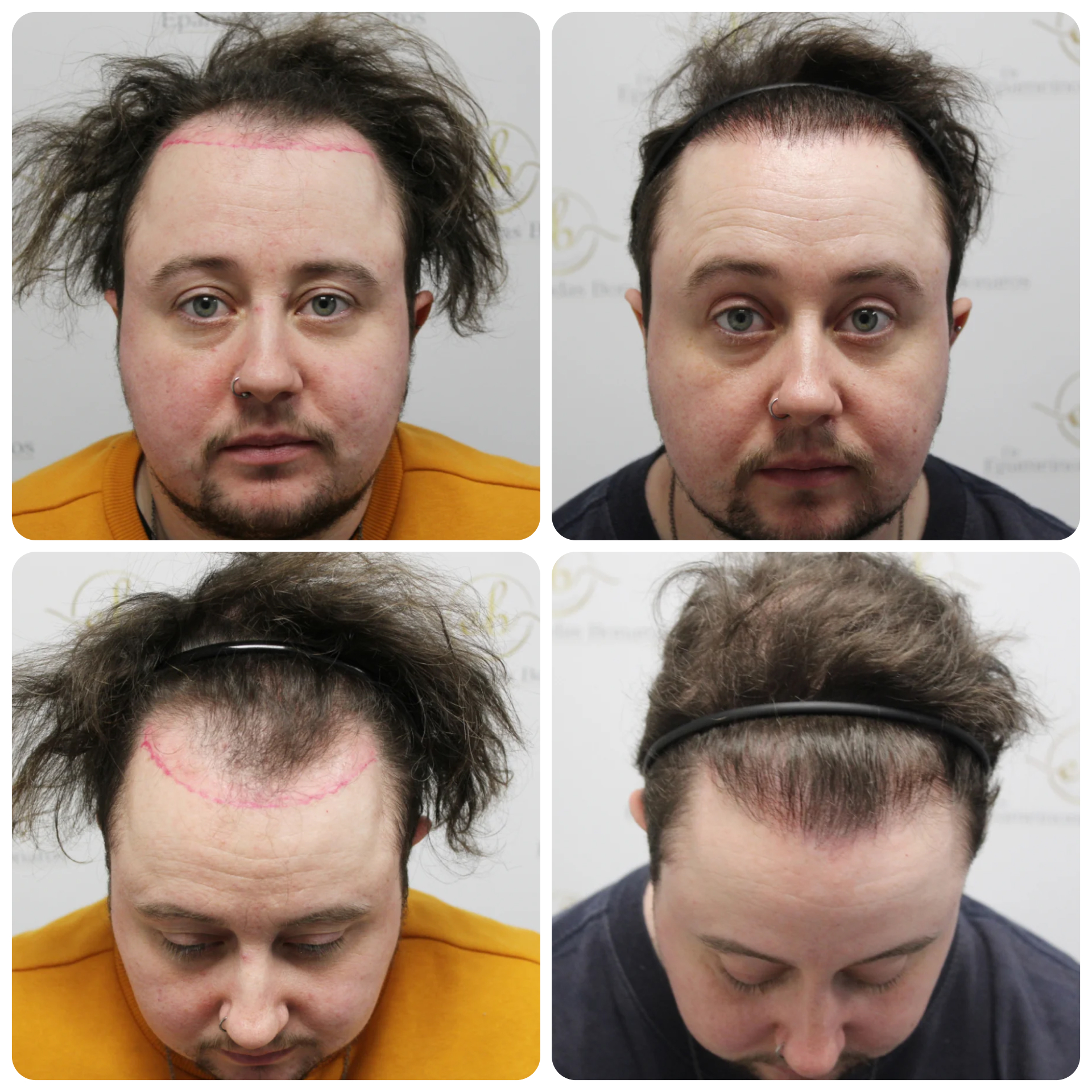 Female to male FUE hairline restoration
