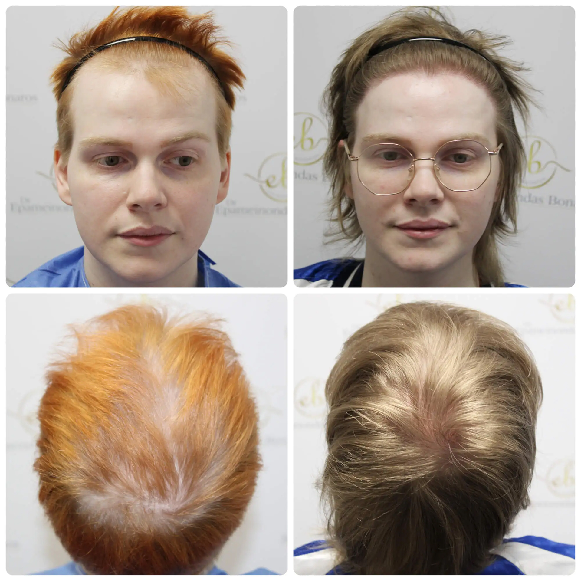Male to female feminising hairline lowering