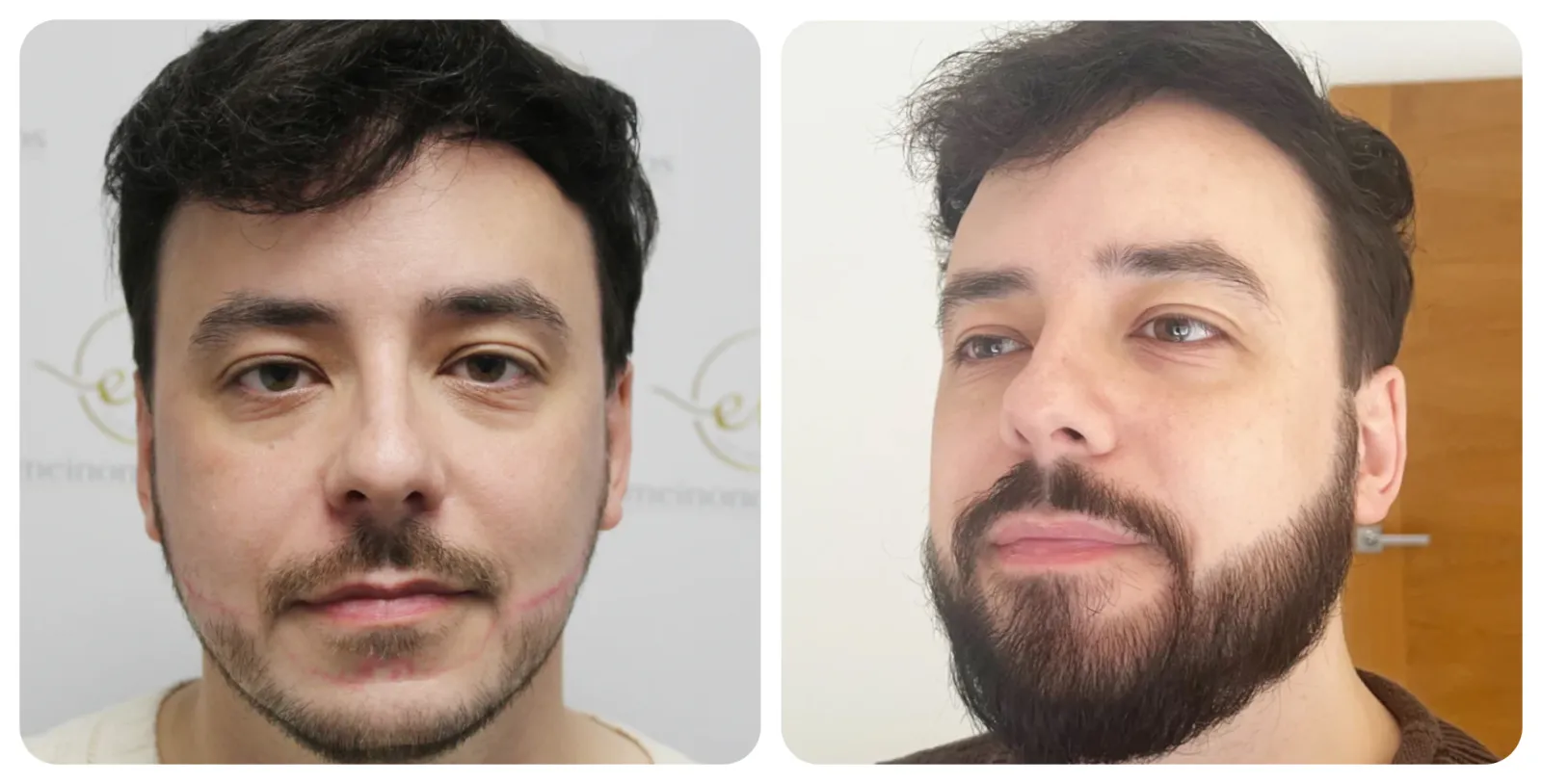 Beard<br>Restoration