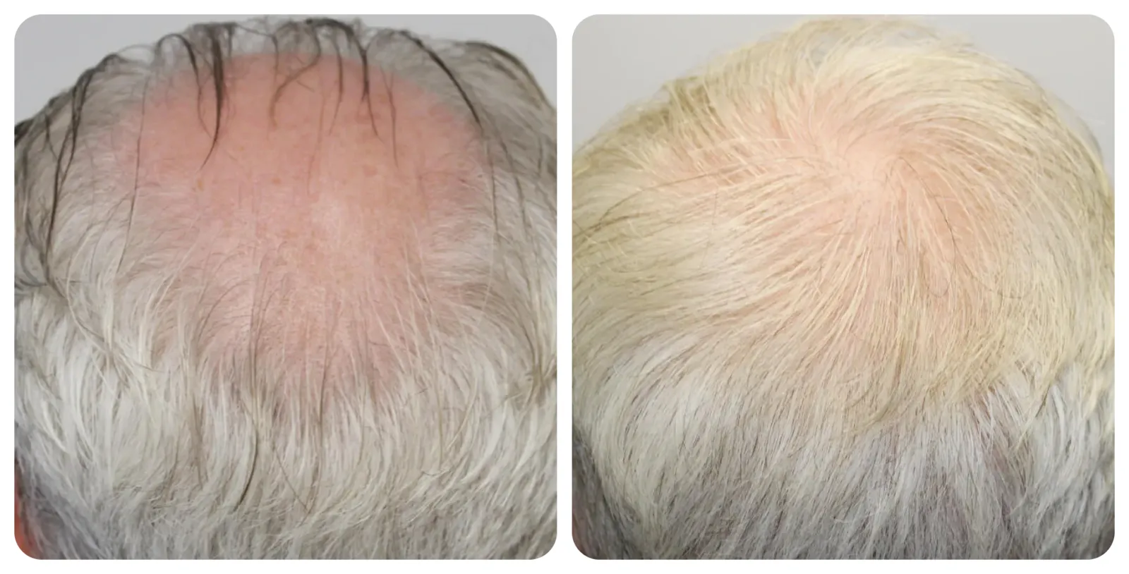 Crown Hair<br>Transplant