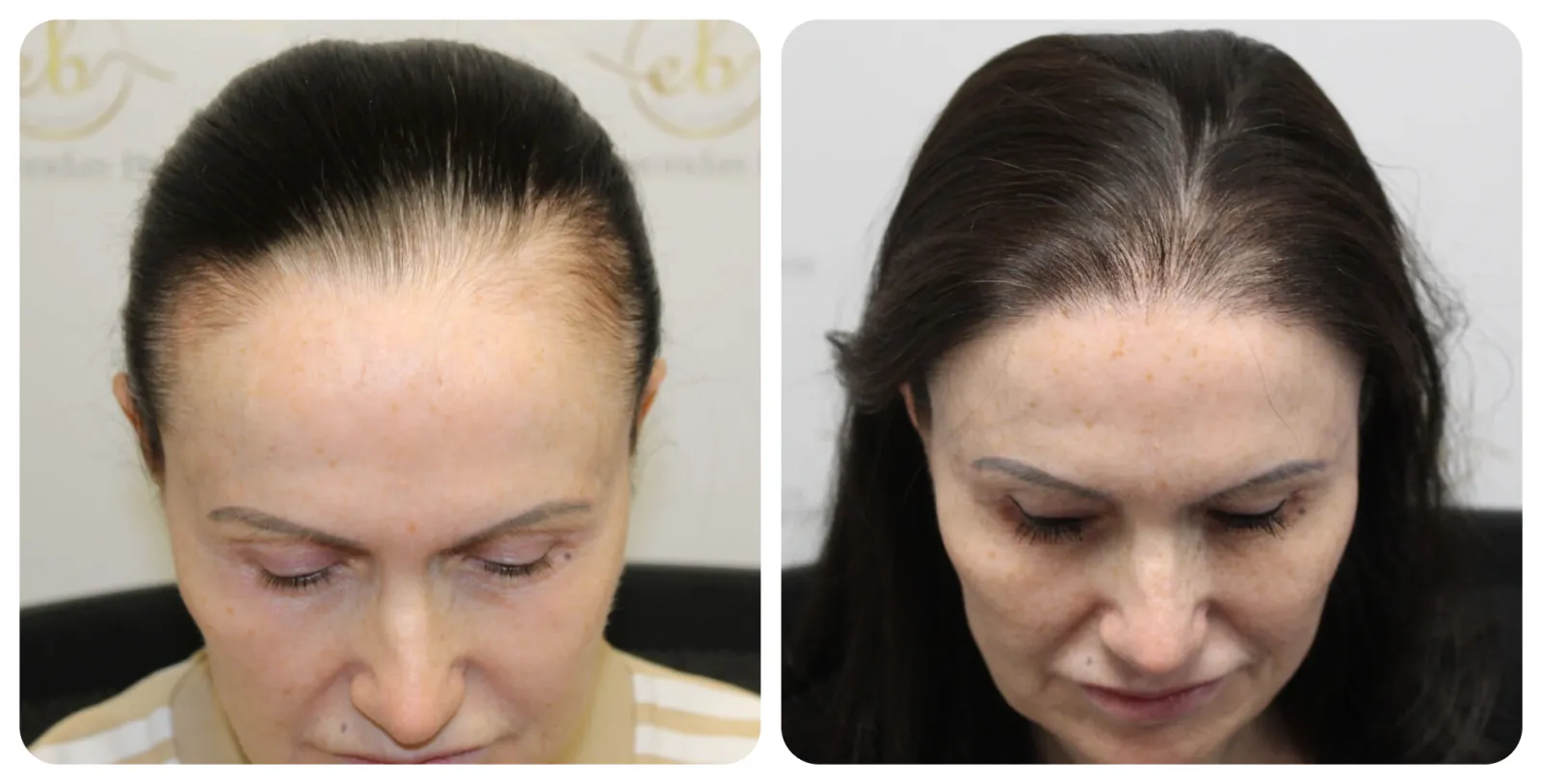 Female Hair<br>Transplant