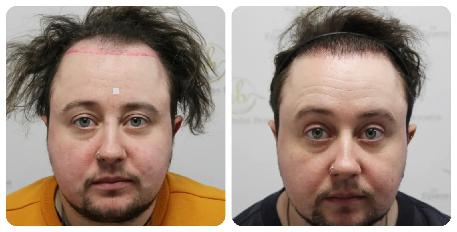 FtM Hair<br>Transplant