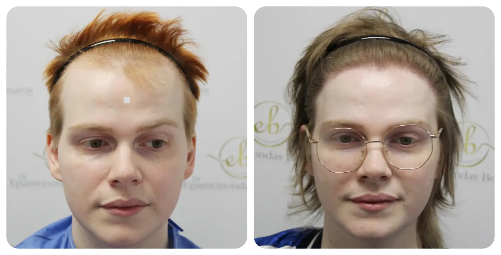 FUE Hair<br>Transplant