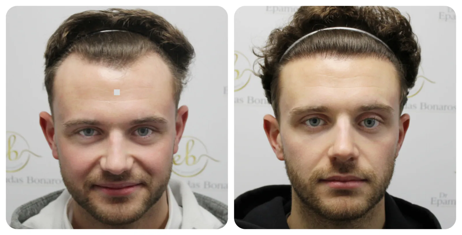 Hairline<br>Transplant