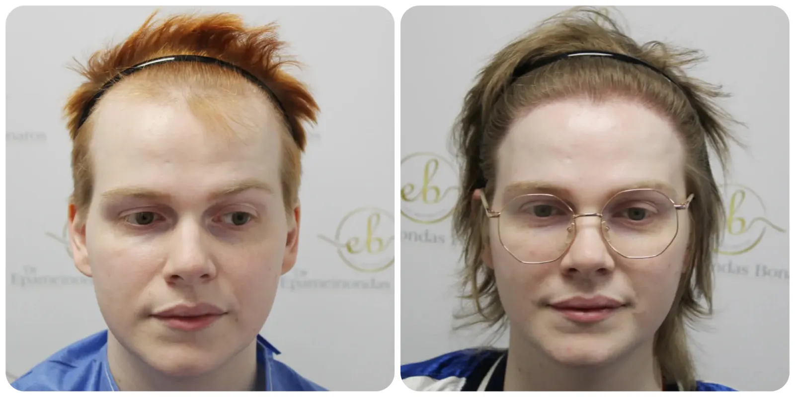 MtF Hair<br>Transplant
