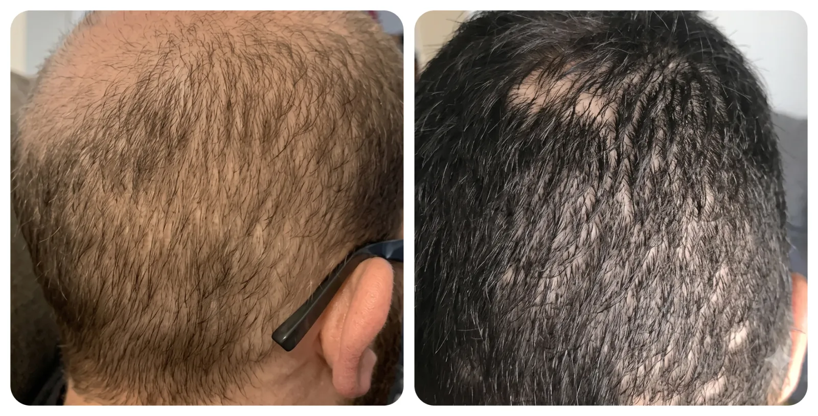 Non-Surgical<br>Hair Treatment