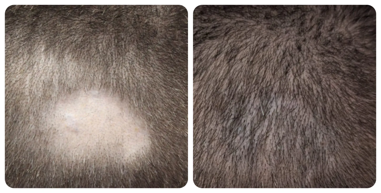 Scar Repair<br>Hair Transplant