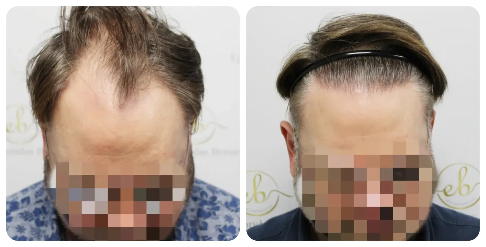 Unshaven FUE<br>Hair Transplant
